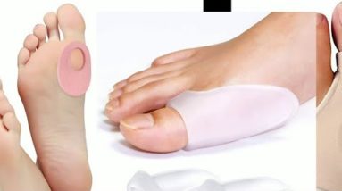 Busting myths about bunions: How new procedure can make a difference