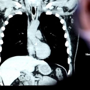 Patients at low risk may still develop lung cancer