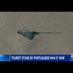 South Beach Tourist Stung By Portuguese Man O' War